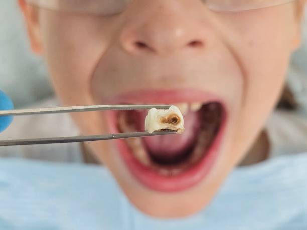 Best Emergency Tooth Extraction in Zephyrhills West, FL